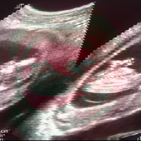 น้ำหนักไม่ขึ้นเลยคะต้องทำไงคะ