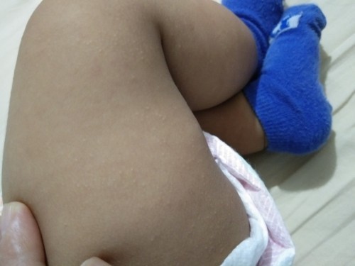 What's in my baby's thigh ?