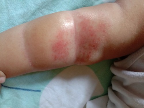 Rashes?????