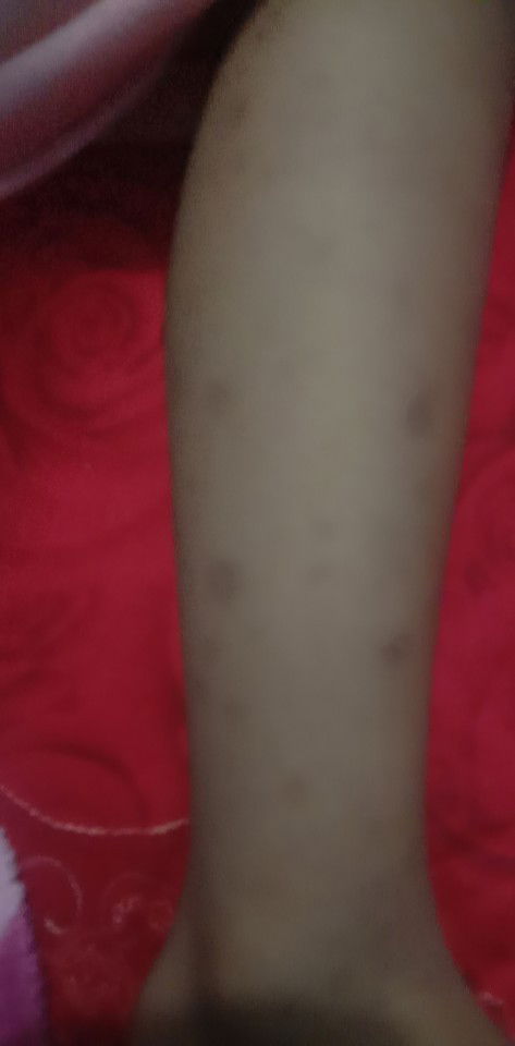 Kulit anak elergik , tnya ibu2 disini