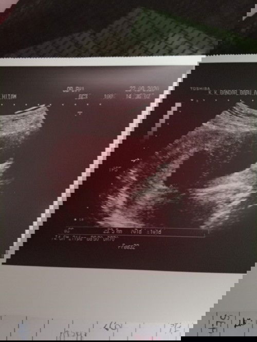 Hye,mommy ada yg blh bagi tau saya tentang fotobscan ini?
Saya last priod 20.7.2020 scan tgl 22.9.20