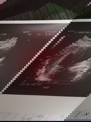 Hye,mommy ada yg blh bagi tau saya tentang fotobscan ini?
Saya last priod 20.7.2020 scan tgl 22.9.20