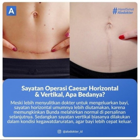VBAC ( lahiran normal setelah caesar )