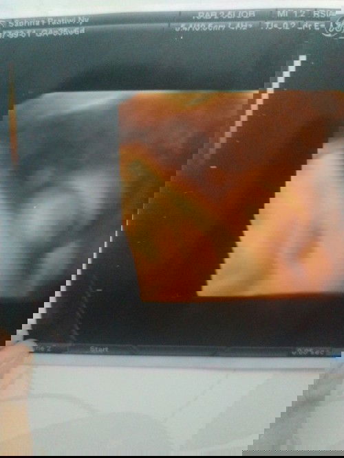 PENGALAMAN MELAHIRKAN NORMAL TANPA INDUKSI