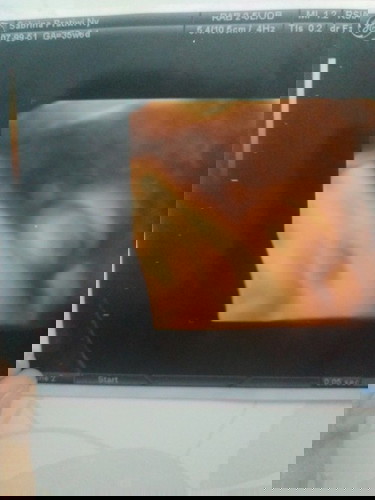 PENGALAMAN MELAHIRKAN NORMAL TANPA INDUKSI