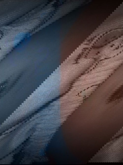 Rốn bị chảy nước 😥