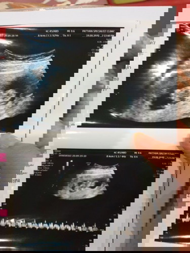 ตอนนี้ท้อง 11 weeks แล้วค่ะ แต่แพ้ท้องหนักมาก น้ำลายไหลตลอดเวลา ต้องคอยบ้วนทิ้งตลอดมีใครเป็นแบบนี้