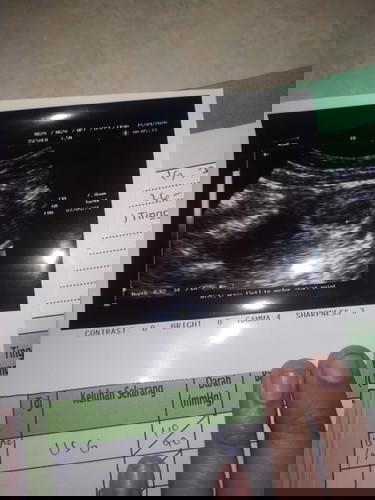 USG usia kehamilan 6w4d