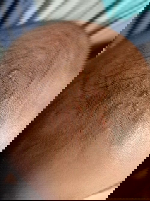 Ubun-ubun / kepala anak ada bintik