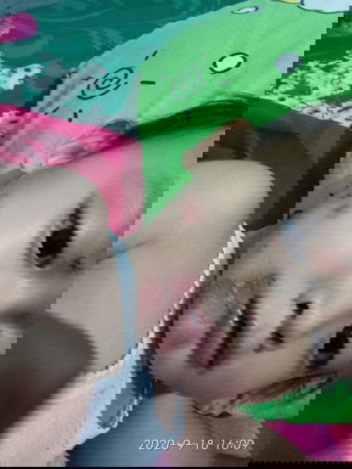 Ada yg bilang cacar ada yg bilang herves