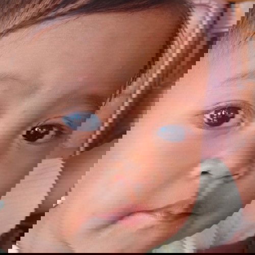 bercak putih dikulit wajah