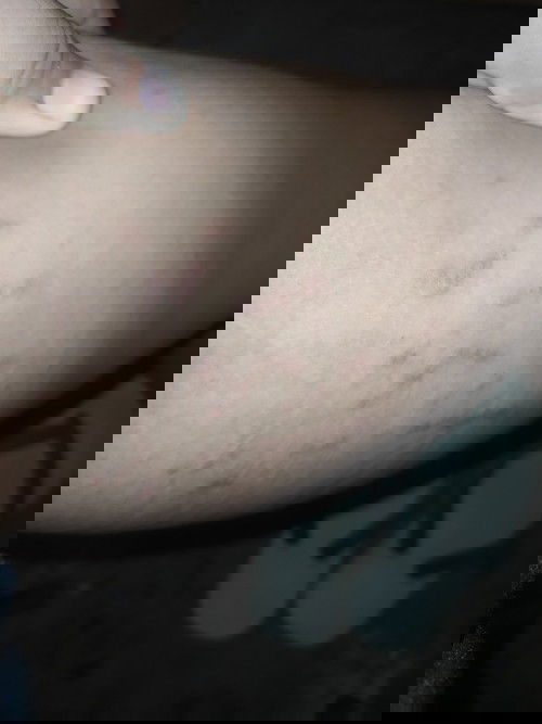 Stretchmark bukan?
