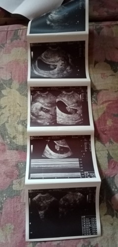 Transvaginal Ultrasound