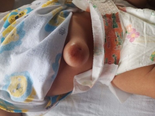 น้องได้1เดืออนกับ 25วันค่ะ สะดือน้องใหญ่มากค่ะ.  จะเป็นไรมั้ยค่ะ. น้องเลี้ยงง่าย ไม่ค่อยร้อง ค่ะ