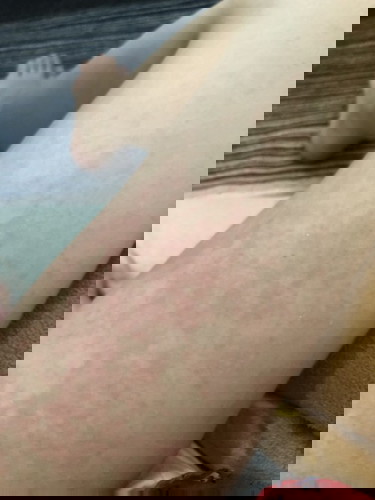 ผื่นแดง หลังคลอดลูก