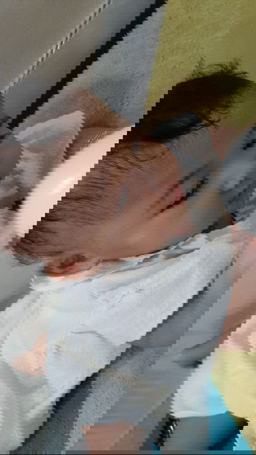 Rambut tumbuh tidak rata.