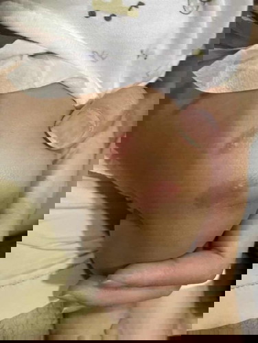 ขอถามเรื่องตุ่มแดงค่ะ