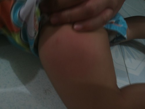 Bekas Suntikan 1tahun 6bulan