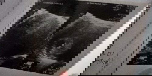 Kehamilan dengan myoma