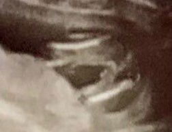 ช่วยดูเพศทีค่ะตอนไปหาหมอ 15 week   หมอบอกผู้ชาย แต่คุณพ่อเค้าไม่เชื่อ 😅