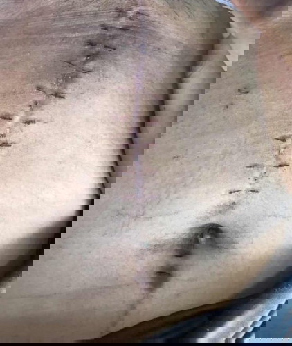 มีแม่บ้านไหนผ่าคลอดแบบนี้บ้างมั้ยคะ