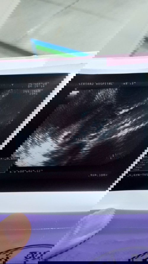 มีใครเจอถุงตั้งครรภ์อยู่สูงไปในมดลูกบ้างไหมคะ อีก 2 อาทิตย์คุณหมอนัดตรวจคลื่นความถี่ เพื่อดูตำแหน่ง