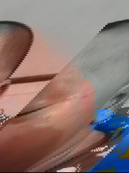 ada bintik2 merah diarea wajah leher dan belakang kepala