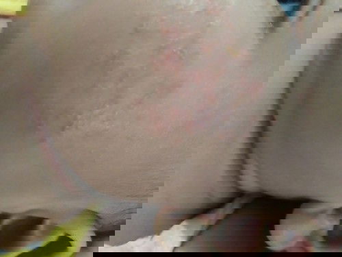 Ruam pipi pada bayi 2 bulan