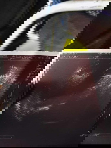 Anembryonic Pregnancy po ba ito? , or maghintay lang po ako?