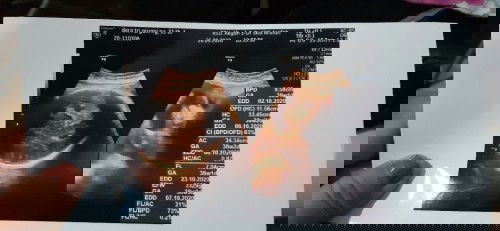 37week Leher bayi malah terlilit dan posisi kepala di atas padahal 2minggu sblumnya kepala di bawah