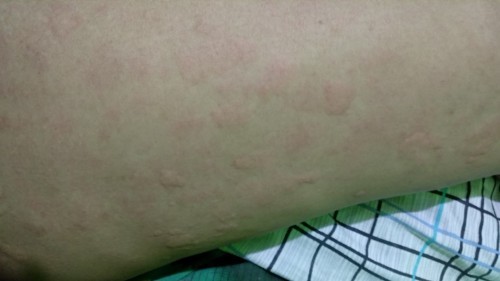 moms.. ada yg pernah biduran / kaligata ga? gatelnya gakuat, ngobatinnya pake apa ya?