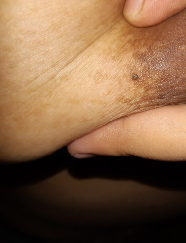 Hello mga sis! Ask ko lang, normal ba sa buntis yung may itim sa my suso. Thanks! 29w1d pregnant π