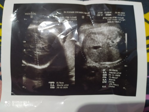 Tiba 35w malah sungsang + terlilit tali pusar 1 longgar😭🙏