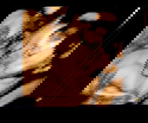 น้องนอนคอเอียงตลอด