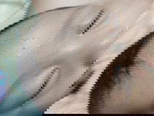 Worried about facial rashes