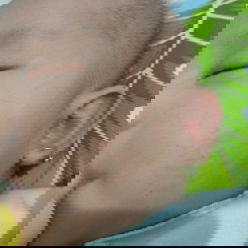 bercak merah dan gatal pada bayi