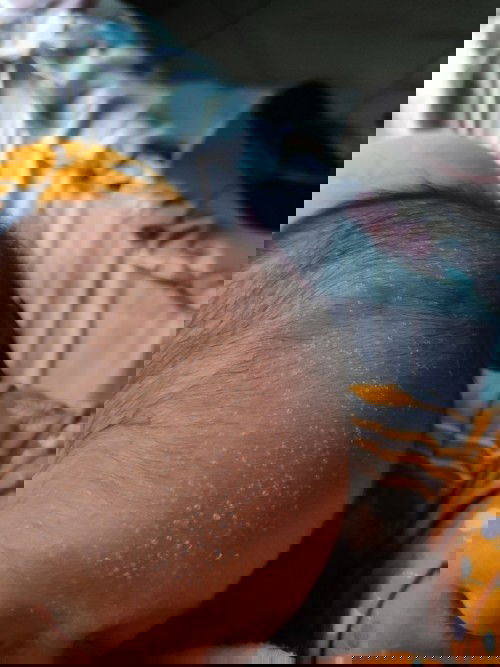 bintik bintik di dahi n kepala bayi