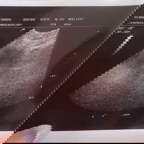 Usg usia kehamilan 6 minggu apakah seperti ini? Mohon info karna baru pertama kali hamil dan ke Dr kandungan