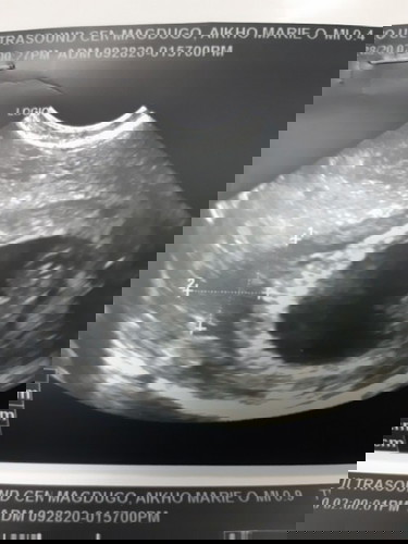 Subchorionic Hemorrhage