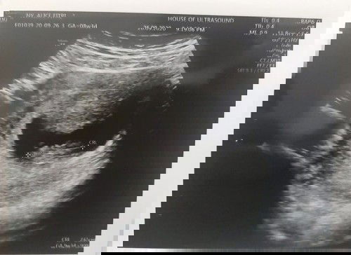 Usia Kehamilan Hpht dan Usg