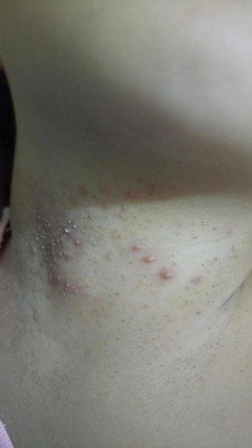 Skin Rashes