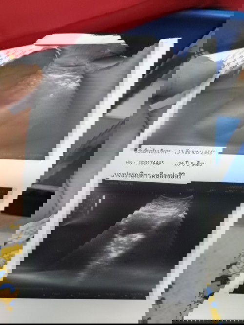 เมื่อวานแอบไปซาวด์ดูน้อง(เห็นแต่ถุง)​ก่อนหมอโรงบาลนัดใจร้อนเพราะก่อนหน้านี้เกือบ2อาทิตย์​มีเลือดออก