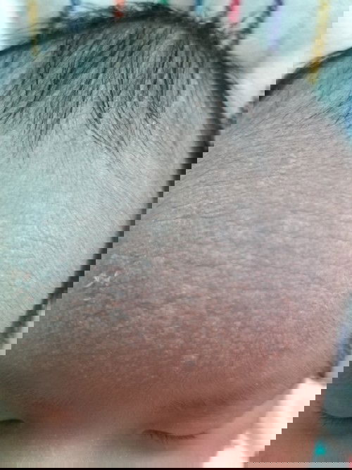 Cara menghilangkan biang keringat di jidat bayi