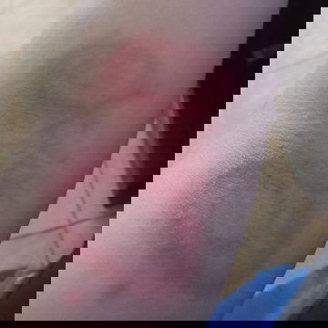 Luka di lekukan tangan