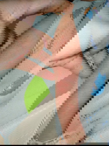 น้องเป็นตุ่มแบบนี้น้องเป็นอะไรอะค่ะ