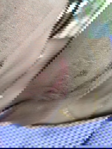 อยากๆด้ข้อมูลครับ ตอนนี้ภรรยาท้องได้ 6 เดือนแล้วมีอาการปวดฟัน  เลยซื้อโกเอี๊ยะมาแปะ เป็นแผลเลย