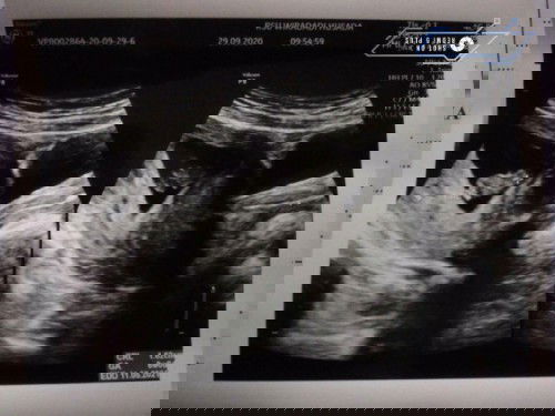 flek di usia kandunagn 8 minggu