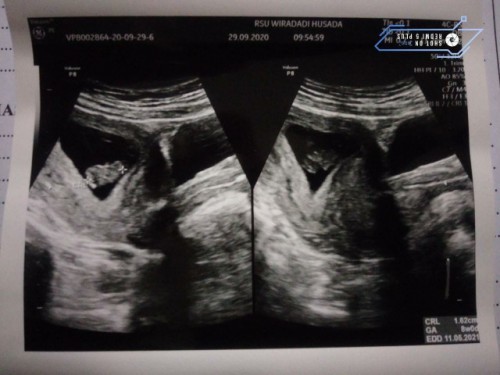 flek di usia kandunagn 8 minggu