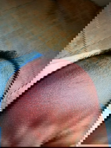 White Skin Spots Like Dandruff