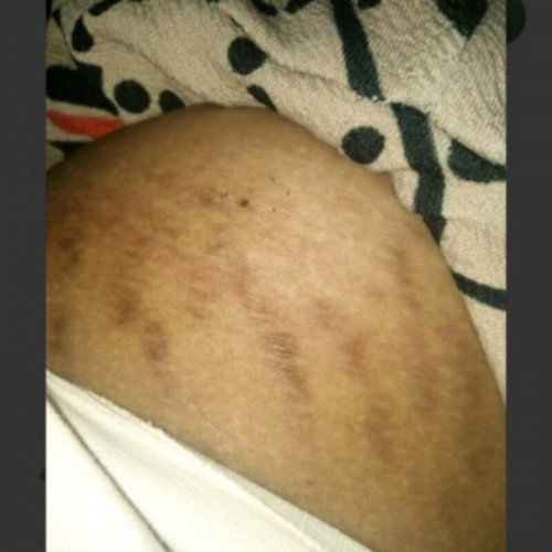 Strechmark hitam setah melahirkan